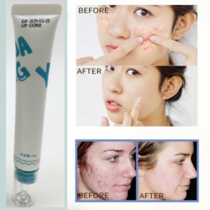 Alternative view of Private Label Skin Care Repair Anti Acne Pimple Removal Gel Tea Tree Herbal Acne Care Skin Treatment for All Skin Types